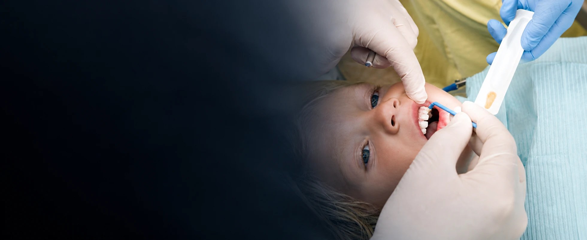Fluoride treatment in Carlsbad