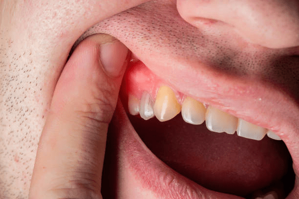 Why Does My Tooth Filling Hurt After Months?