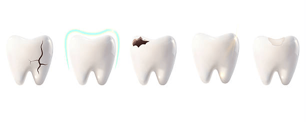 How to Fix a Chipped Tooth
